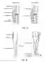 Fig. 06 - Treatment of incompetent vessels