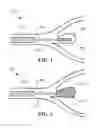 Fig. 02 - Stent with expandable foam
