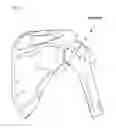Fig. 02 - Method of humeral head resurfacing and/or replacement and system for accomplishing the method