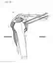 Fig. 07 - Method of humeral head resurfacing and/or replacement and system for accomplishing the method