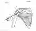 Fig. 11 - Method of humeral head resurfacing and/or replacement and system for accomplishing the method