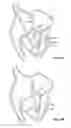 Fig. 16 - Mitral valve repair devices