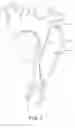 Fig. 02 - Aortic dissection septal cutting tool