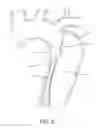 Fig. 03 - Aortic dissection septal cutting tool