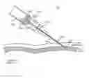 Fig. 04 - Solid Introducer Needle for Catheter