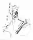 Fig. 13 - PERICARDIAL ACCESS DEVICE