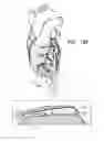 Fig. 23 - PERICARDIAL ACCESS DEVICE