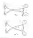 Fig. 03 - SURGICAL INSTRUMENT WITH MOVABLE GUIDE AND SLEEVE