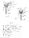 Fig. 05 - Conforming bone stabilization receiver