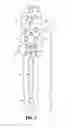 Fig. 03 - Fixation device for proximal humerus fractures