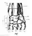 Fig. 02 - Pancarpal arthrodesis bone plate