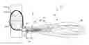 Fig. 01 - Tensioning instrument and related bone fixation systems and methods