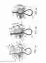 Fig. 06 - Bone fixing system and method of use