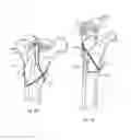 Fig. 15 - Bone fixing system and method of use
