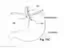 Fig. 34 - Methods and devices for applying energy to bodily tissues