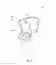Fig. 09 - Method and system for aligning a prosthesis during surgery