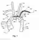 Fig. 02 - Embolic protection device and method