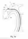 Fig. 07 - Embolic protection device and method