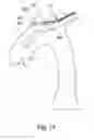 Fig. 08 - Embolic protection device and method