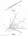 Fig. 02 - Method of inserting a vein filter