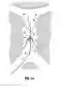 Fig. 08 - Method of inserting a vein filter