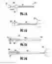 Fig. 16 - Method of inserting a vein filter