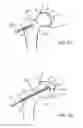 Fig. 06 - Devices and methods for minimally invasive access into a joint
