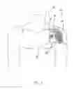 Fig. 02 - Implantable tendon protection systems and related kits and methods