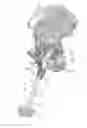 Fig. 01 - Acetabular cup impacting using patient-specific instrumentation