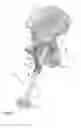Fig. 02 - Acetabular cup impacting using patient-specific instrumentation