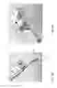 Fig. 06 - Acetabular cup impacting using patient-specific instrumentation