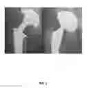 Fig. 02 - Acetabular component anteversion and abduction measurement system and method