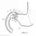 Fig. 02 - Gastrointestinal device