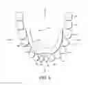 Fig. 04 - MANDIBULAR ADVANCEMENT DEVICE