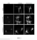 Fig. 17 - Composition and method for treating neuronal ceroid lipofuscinosis