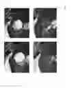 Fig. 07 - Hemostatic foam