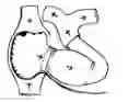 Fig. 01 - Permanent total artificial heart device