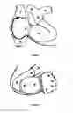 Fig. 04 - Permanent total artificial heart device