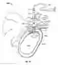 Fig. 09 - Tissue bonding implantation device and method