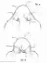 Fig. 07 - CONVERTIBLE SWIMSUIT AND METHOD FOR ASSEMBLING SAME