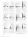 Fig. 08 - Estimating distribution, fluctuation and/or movement of electrical activity through a heart tissue