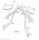 Fig. 14 - Labor management devices for pelvic floor support