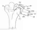 Fig. 01 - Patient-specific elbow guides and associated methods