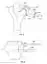 Fig. 06 - Patient-specific elbow guides and associated methods