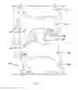 Fig. 02 - Lamina implant and method