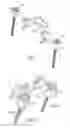 Fig. 05 - Device for fixing a bony structure to a support member