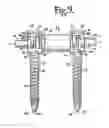 Fig. 04 - Dynamic spinal stabilization assemblies, tool set and method