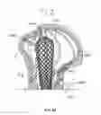 Fig. 49 - Apparatus and methods for fracture repair