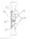 Fig. 01 - Devices for treating bone fractures