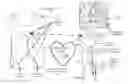 Fig. 01 - SYSTEM AND METHODS FOR USING BODY SURFACE CARDIAC ELECTROGRAM INFORMATION COMBINED WITH INTERNAL INFORMATION TO DELIVER THERAPY